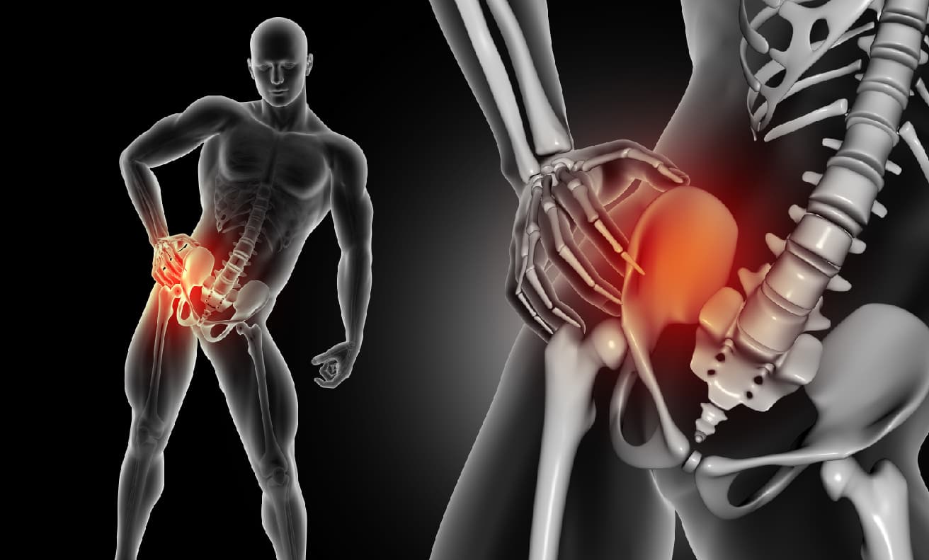 Ciática: causas, tratamiento fisioterapéutico y cómo aliviar el dolor